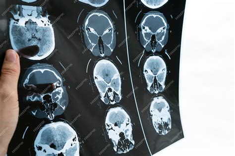 Imagen de una tomografía 3D de un cráneo con craneosinostosis