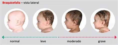 Comparación visual entre plagiocefalia posicional y braquicefalia posicional
