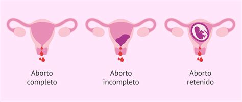 Ilustración que muestra los diferentes tipos de aborto espontáneo (anembrionado, embrionado, completo, incompleto)