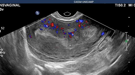 Ecografía transvaginal mostrando un endometrio post-aborto con posibles restos ovulares