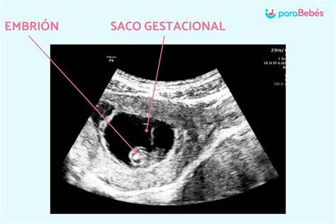 Esquema del útero con un saco gestacional y embrión en desarrollo temprano