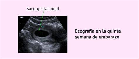 Ecografía mostrando un saco gestacional con posible irregularidad