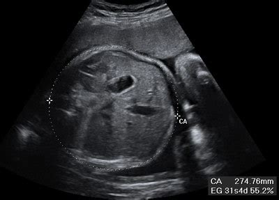 Ecografía 2D mostrando la medición del perímetro abdominal fetal