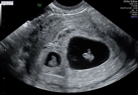 Ecografía de embarazo gemelar con dos sacos gestacionales