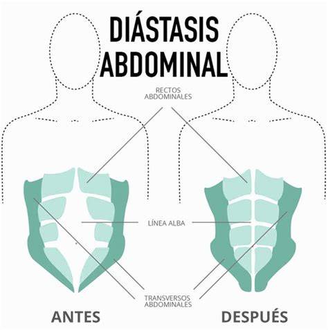 Foto comparativa abdomen normal vs abdomen con diástasis