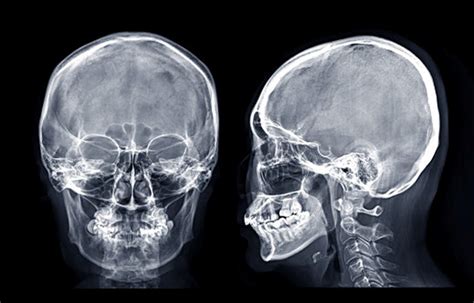Esquema comparativo entre radiografía de cráneo y TAC cerebral
