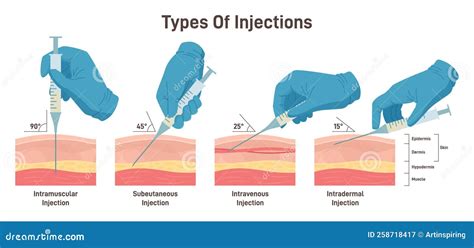 Ilustración de la técnica de inyección intraamniótica para feticidio.