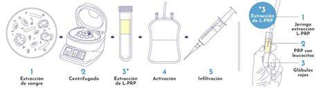 Ilustración del proceso de aplicación de PRP en el útero