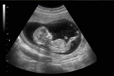 Imagen de una ecografía fetal mostrando mediciones