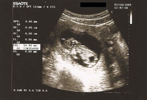 Ecografía fetal mostrando megavejiga dilatada
