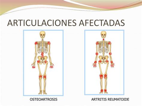 Esquema de las articulaciones afectadas por artritis reumatoide