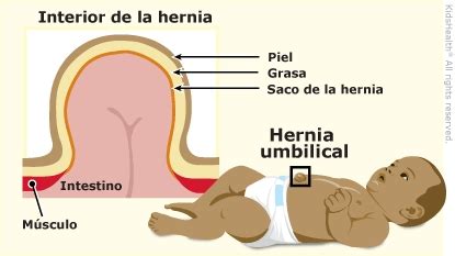 Diagrama anatómico del ombligo y la pared abdominal con una hernia umbilical