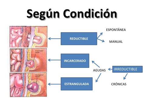 Infografía explicando la incarceración y estrangulación de una hernia