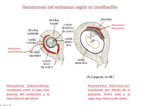 Esquema del útero con un saco gestacional y un hematoma subcoriónico