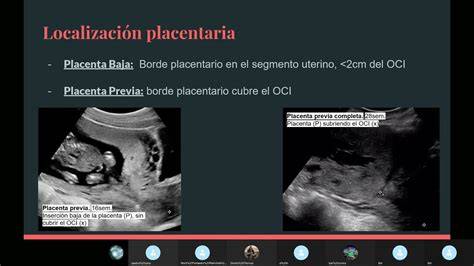 Ecografía mostrando una placenta anterior y la posición del feto