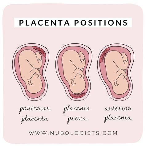 Infografía mostrando las diferentes posiciones de la placenta: anterior, posterior, previa
