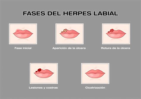 Ilustración de ampollas de herpes labial en los labios de un niño