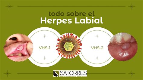 Infografía: etapas del herpes labial (hormigueo, ampollas, costra, curación)