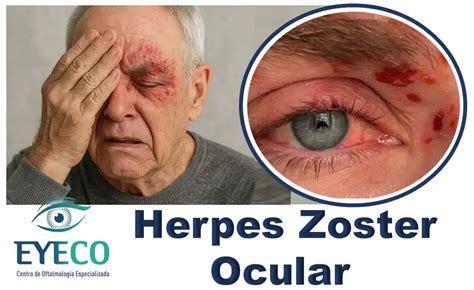 Diagrama mostrando la afectación ocular por herpes