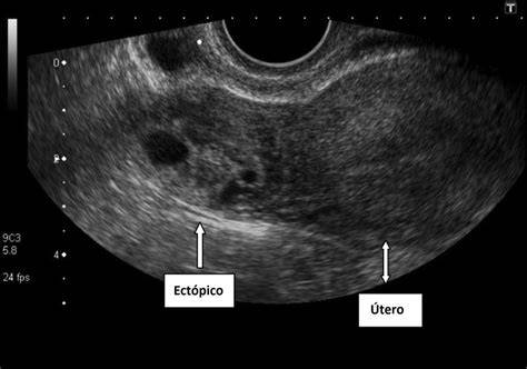 Esquema comparativo de una implantación uterina normal y diversas localizaciones de un embarazo ectópico en ecografía