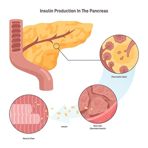 Esquema de la resistencia a la insulina durante el embarazo, mostrando el páncreas, la placenta y las células del cuerpo