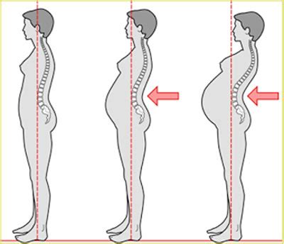 Ilustración de los cambios posturales en el embarazo: lordosis lumbar y desplazamiento del centro de gravedad
