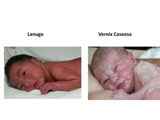 Ilustración de la relación entre lanugo y vérnix caseosa en la piel fetal