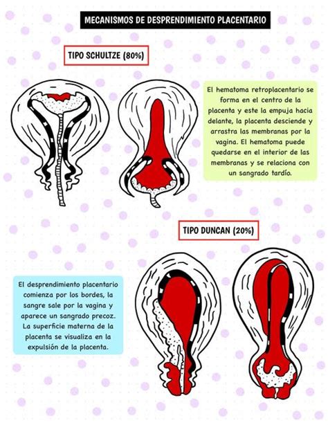 Diagrama comparativo de los mecanismos de desprendimiento placentario tipo Schultze y Duncan