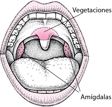 Ilustración de la anatomía de las amígdalas y adenoides, mostrando su tamaño antes y después de la adenoamigdalectomía