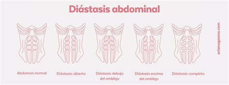 Ilustración anatómica del suelo pélvico y la diástasis abdominal