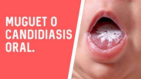 Foto de candidiasis oral (muguet) en la boca de un bebé