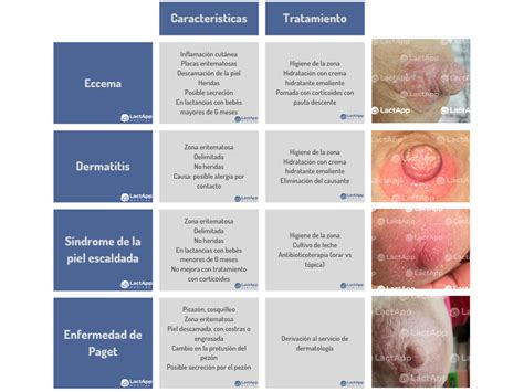 Tabla comparativa de síntomas entre candidiasis del pezón, eczema y mastitis bacteriana