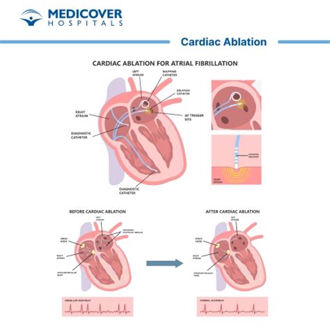 Diagrama: Procedimiento de ablación con catéter cardíaco