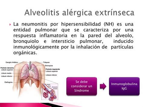Diagrama que ilustra el proceso de inflamación pulmonar en la neumonitis por hipersensibilidad tras la exposición a antígenos.