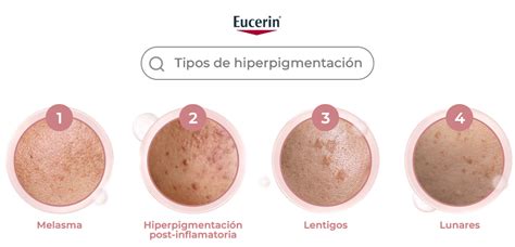 Comparación de hiperpigmentación periungueal en recién nacidos negroides y mongoloides