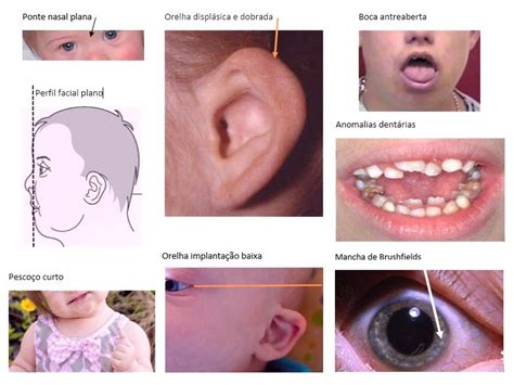 Colagem de fotos ilustrando as características físicas comuns em bebês com Síndrome de Down.