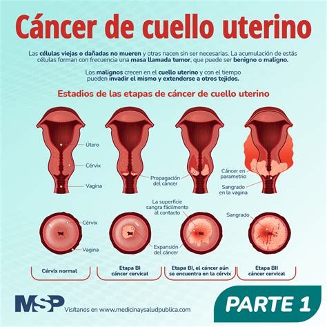 Diagrama del cuello del útero y las células que se examinan en una citología.