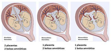 Esquema de un útero mostrando un embarazo gemelar inicial y la posterior reabsorción de uno de los embriones.