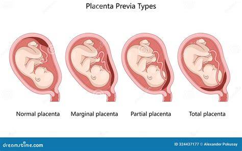 Esquema anatómico mostrando la posición normal de la placenta frente a las diferentes variedades de placenta previa (marginal, parcial y oclusiva/total).