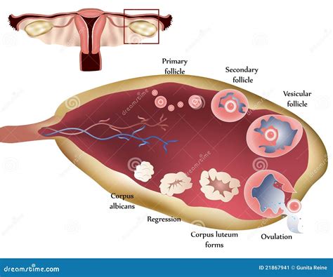 Diagrama anatómico del ovario con un cistoadenoma multiloculado.
