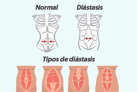 Diagrama de diástasis abdominal postparto