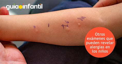 infografía sobre cómo realizar una prueba de alergia cutánea