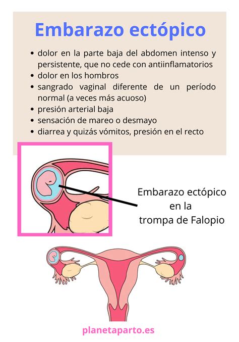 Infografía detallando los síntomas comunes de un embarazo ectópico, con énfasis en el dolor pélvico y el sangrado anormal.