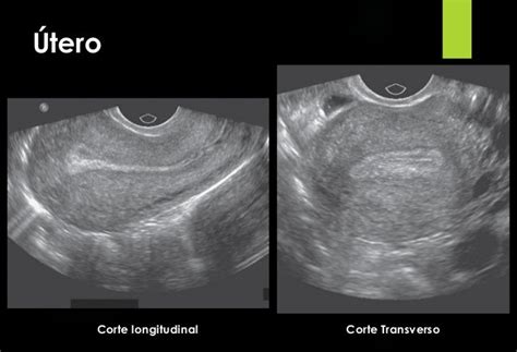 Diagrama de la ecografía transvaginal mostrando útero y ovarios