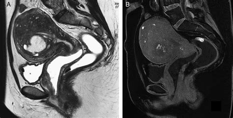 Imagen de resonancia magnética mostrando un endometrioma ovárico