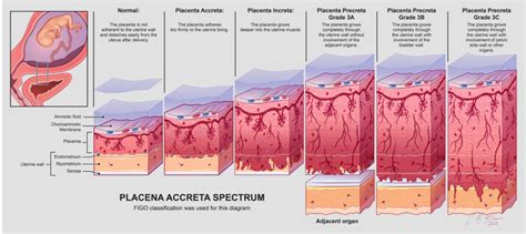 Diagrama del espectro de placenta acreta, mostrando cómo la placenta puede crecer a través de la pared uterina.