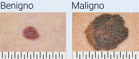 Diagrama mostrando las características de un lunar benigno versus un lunar sospechoso de malignidad (regla ABCDE).
