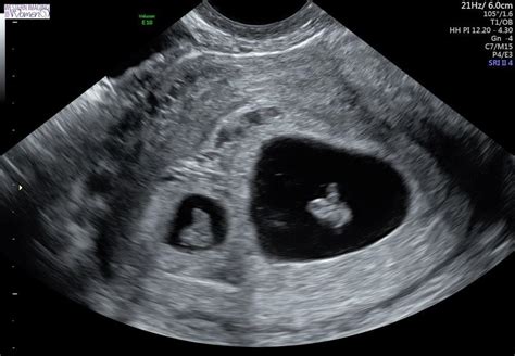 Ecografía mostrando dos sacos gestacionales con embriones en las primeras semanas de embarazo.