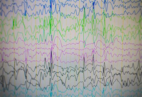 Esquema anatómico del cerebro mostrando focos de actividad eléctrica anormal durante una crisis convulsiva