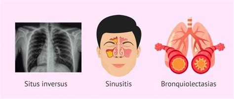 Esquema ilustrativo que muestra la tríada clásica del Síndrome de Kartagener: sinusitis, bronquiectasias y situs inversus.